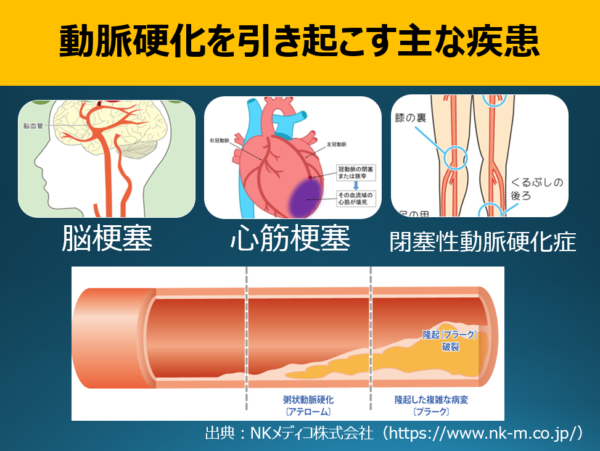 血管断面図とプラーク