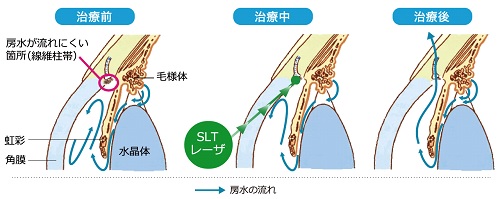 選択的レーザー線維柱帯形成術の説明の図