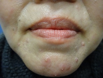 45歳　女性のマスク肌荒れの写真