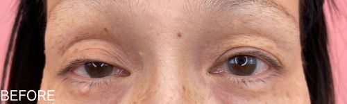 眼瞼下垂の患者のビフォー