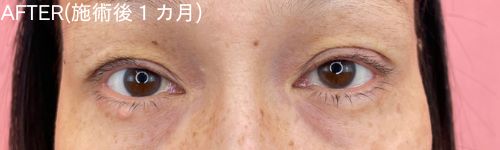 眼瞼下垂の患者のアフター